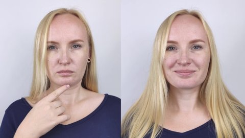 Second chin lift in women. Video before and after plastic surgery, mentoplasty or facebuilding. Chin fat removal and face contour correction