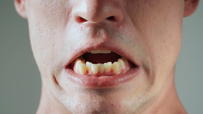 The man shows his yellow crooked and protruding teeth. Malocclusion. Close-up. | Shutterstock HD Video #1058248105