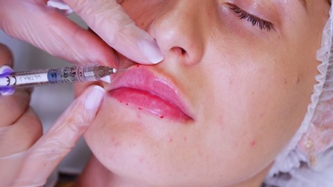 lip augmentation procedure. close-up, female face. The surgeon, in medical gloves, pierces the womens  lip with a syringe and slowly injects hyaluronic acid. beauty injections. Plastic surgery.