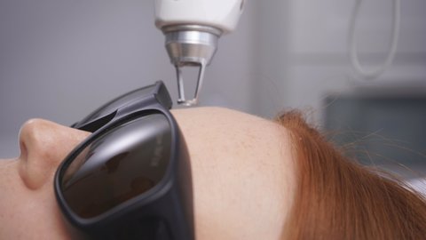 Cosmetic procedure in a modern beauty salon. Close-up of laser skin resurfacing.