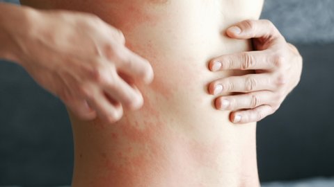 Close-up man scratches a red rash on his stomach in close-up. Allergies and skin diseases