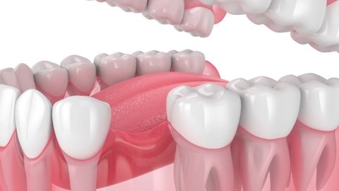 Teeth sliding towards the area of missing tooth. Consequences of tooth loss. 
