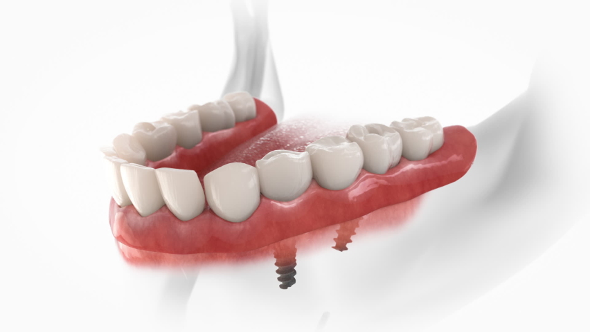 Mandibular fixed prosthesis with 4 implants, posterior are tilted.  3D animation of dental restoration. Royalty-Free Stock Footage #1058555248