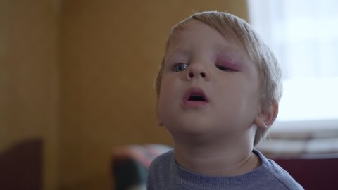 small male child with an injury or a bruise on his face cannot open his eyes due to swelling and bruising obtained after dangerous active games, while taking walk on street on vacation