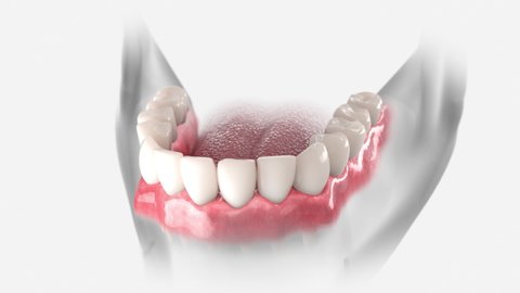 3D animation of dental restoration with dental bridge, supported by two implants. 