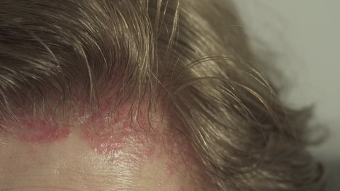 Allergy on the scalp after hair coloring. Swollen face. Skin Reaction