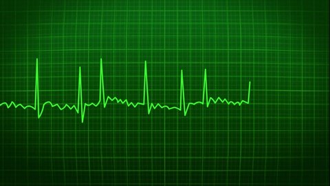 Ecg Heartbeat Heart Fibrillation Atrial Medical Isolated background 