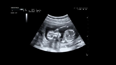 Ultrasonography of pregnant woman. Ultrasound of baby body and spine. Tiny baby is turning in mother's belly. 16 weeks of life. Baby in mother's womb is moving during sonography