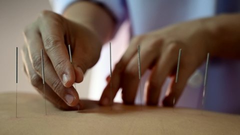 Acupuncture.Close-up Of A Person Getting An Acupuncture Treatment