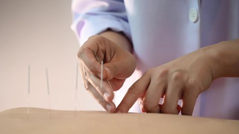Acupuncture.Close-up Of A Person Getting An Acupuncture Treatment