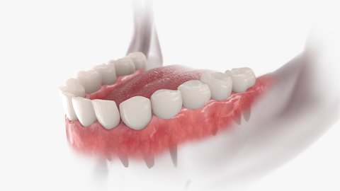 Bridge dental with 3 teeth fixed on molar and premolar. Animation of nstallation process.