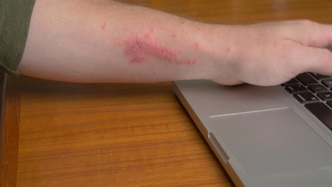 Hiding skin rash or breakout concept.  Man with a skin rash breakout works on computer, before pulling down sleeve to hide red swollen itchy sores on arm.