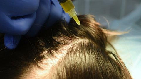 doctor cosmetologist dermatologist injects the plasma into the scalp of the patient. Plasma treatment, plasmolifting or PRP method point the introduction of the patient's own plasma enriched with