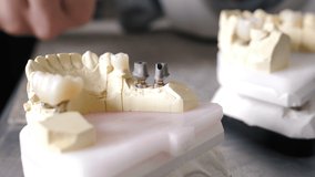 Dental prosthesis, artificial tooth, prosthetic. Male hands setting dental tooth crown on jaw model. hands working on denture. Close-up view. 4 k video