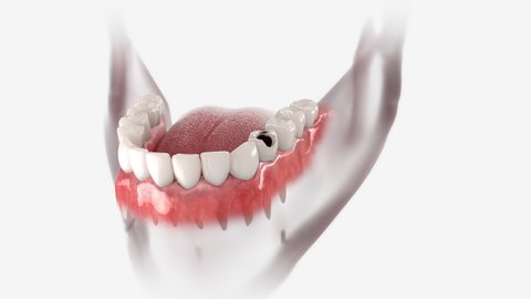 Restoration process of a decayed tooth by means of a dental crown. 