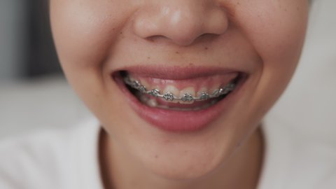 Face of a young smiling asian woman with braces on teeth, Orthodontic Treatment.