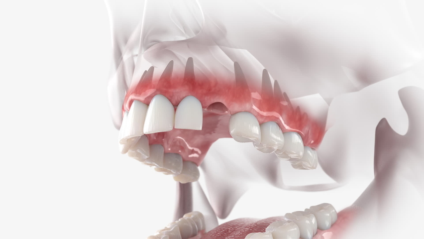Replacement process of maxillary canine with a dental implant. | Shutterstock HD Video #1059195728