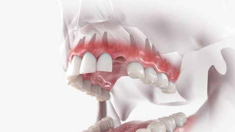 Replacement process of maxillary canine with a dental implant.
