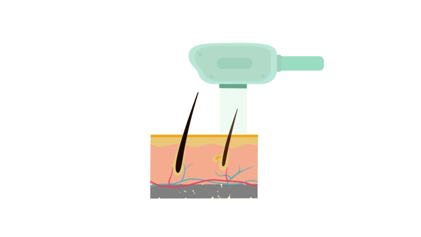 Hair removal laser 2D animation. Skincare, epilation, beauty procedure. Beauty salon concept. Can be used for topics like skin anatomy, body hair. | Shutterstock HD Video #1059200534