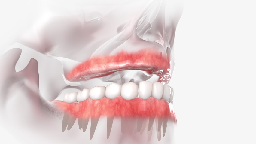 Full arch dental prosthesis of the upper jaw. Royalty-Free Stock Footage #1059412217