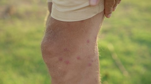 A man on a natural background scratches his legs that were heavily bitten by mosquitoes. Biting insects concept