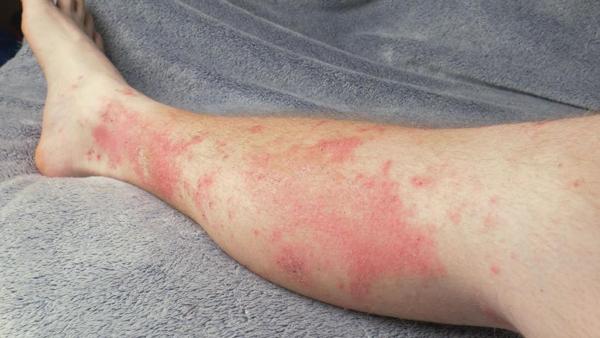 What Causes Red Rash On Lower Legs After Walking