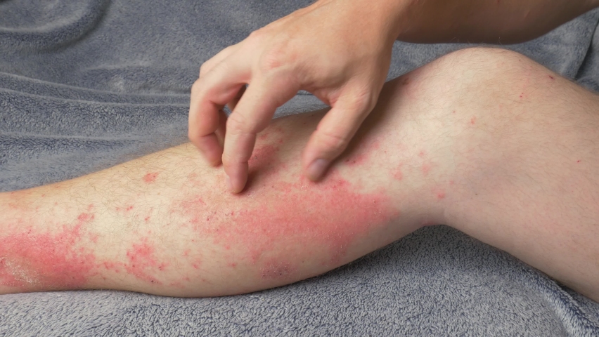Man itching red blotchy reaction on lower leg caused by urushiol, found in poison ivy, and poison oak.  Close up view of hand scratching painful skin irritation.