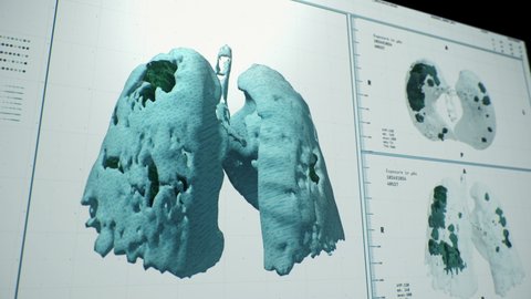 Computer user interface of modern medical scan for covid-19 pneumonia. The screens show the actual process of scanning a patient with CT scan of the lungs.
