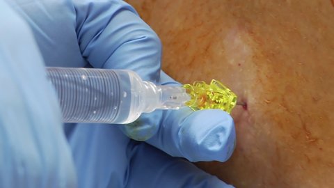 Close-up of Medication Being Injected Via Spinal Tap