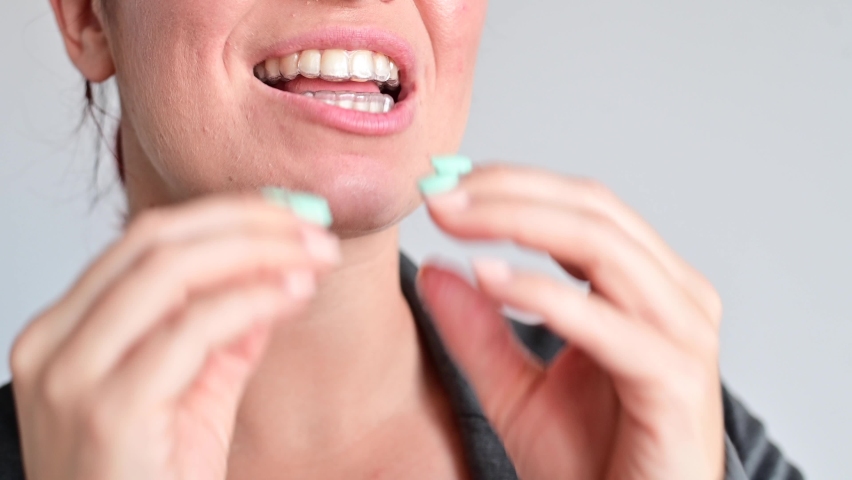 A woman uses transparent retainers to whiten teeth | Shutterstock HD Video #1060180124