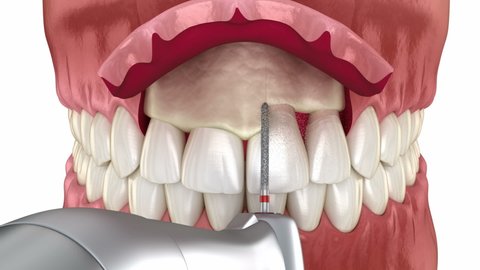 Frontal crown lengthening, Esthetic surgery. Medically accurate dental 3D animation
