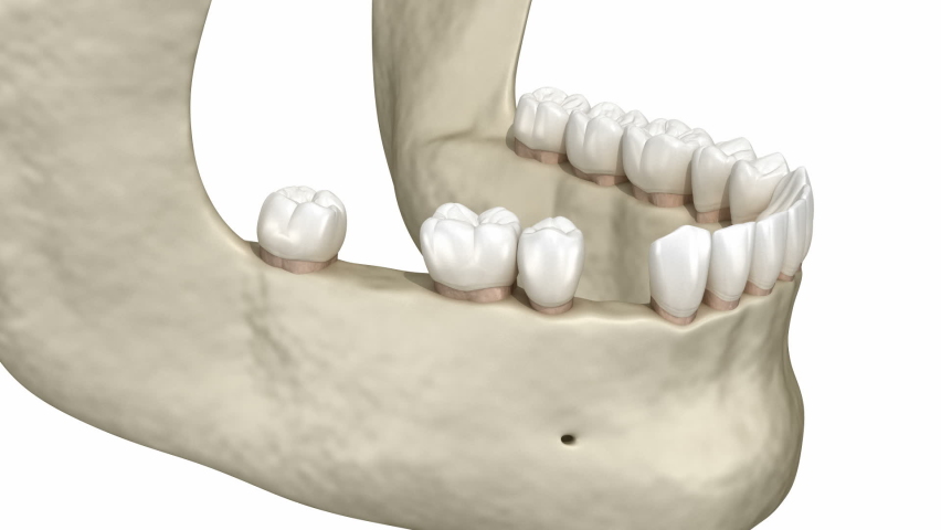 Teeth shift deformatiuon after losing teeth. 3D animation of Popov Godon phenomenon Royalty-Free Stock Footage #1060189109