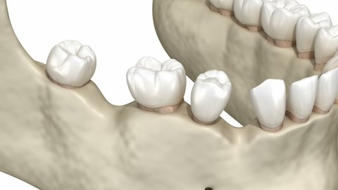 Teeth shift deformatiuon after losing teeth. 3D animation of Popov Godon phenomenon