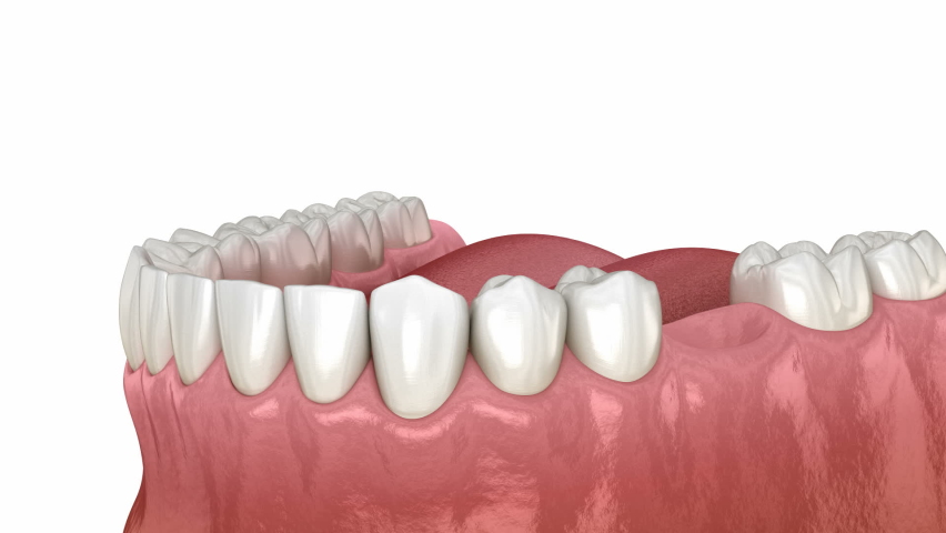 Dental implant instalation, custom abutment and ceramic crown. Medically accurate tooth 3D animation  Royalty-Free Stock Footage #1060189115