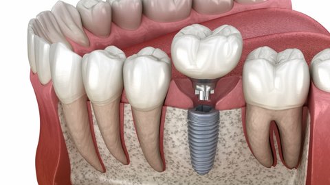Dental implant instalation, custom abutment and ceramic crown. Medically accurate tooth 3D animation 