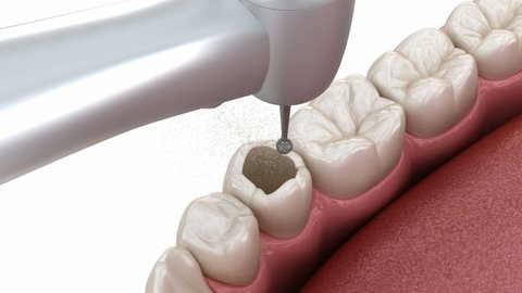 Premolar tooth restoration with composite filling. Medically accurate tooth 3D animation