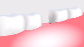Tooth implant medical best video 