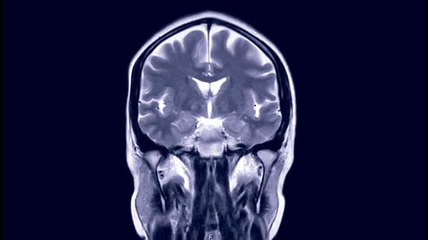MRI brain or magnetic resonance imaging in Coronal T2W view.