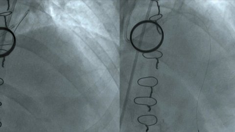Coronary intervention of left main coronary stenosis of patient status post  aortic valve prostesis replacement.