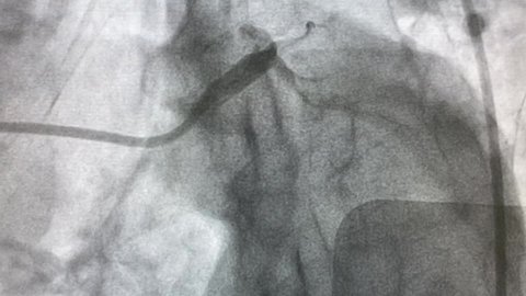 coronary angiogram show chronic total occlusion at left anterior descending artery and left circumflex artery stenosis