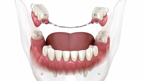 Removable partial denture, mandibular prosthesis. Medically accurate 3D animation of prosthodontics concept