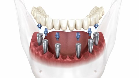 Removable mandibular prosthesis all on 6 system supported by implants. Medically accurate 3D animation of human teeth and dentures