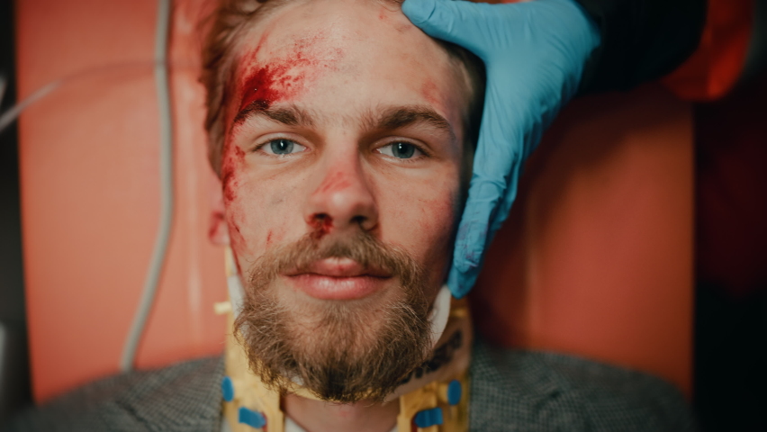 Portrait of an Injured Young Male Patient with Blood Bruising on His Face. Injured Man with a Beard Looking at Camera while Lying on a Hospital Stretcher. Paramedic in Gloves Checks Up on Him.