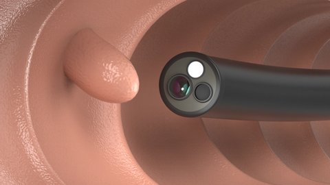 Medical technology concept with 3d rendering endoscope in intestine 4k footage