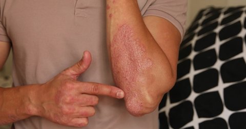 Man with sick hands, dry flaky skin on his hand with vulgar psoriasis, eczema and other skin diseases such as fungus, plaque, rash and blemishes. Autoimmune genetic disease