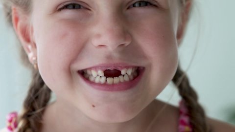 Close-up smile of a girl. A beautiful little girl 6-7 years old has lost milk teeth. Loss of milk teeth, replacement of permanent teeth. Children is dentistry.