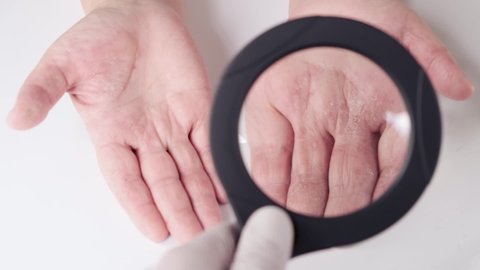 The doctor uses a magnifying glass to examine Dermatitis sore skin. Patient at the appointment of a dermatologist or cosmetologist, choice of treatment