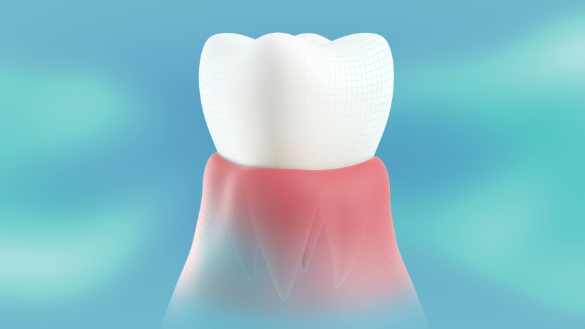 Periodontitis on the gums. Conceptual showing the dental cure of this disease. A healthy tooth is cut in half with the sick one. The video is in a loop.
 | Shutterstock HD Video #1061378965