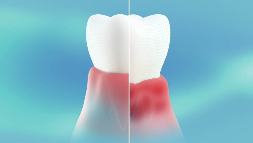 Periodontitis on the gums. Conceptual showing the dental cure of this disease. A healthy tooth is cut in half with the sick one. The video is in a loop.
 | Shutterstock HD Video #1061378965