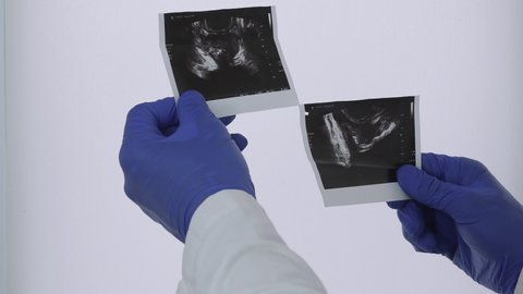 Ultrasound of the prostate gland in the hands of a doctor, a medical professional makes a prostate analysis